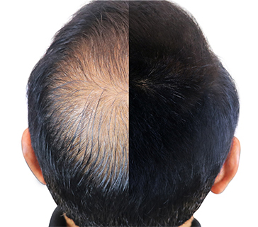 Hair Restoration and Rejuvenation