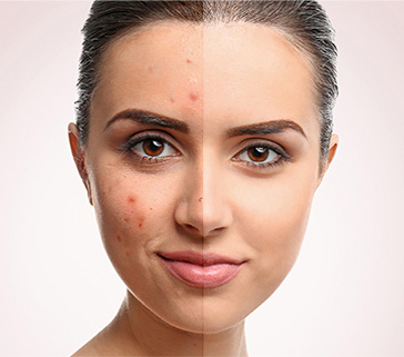 Acne and Other Scar Treatments